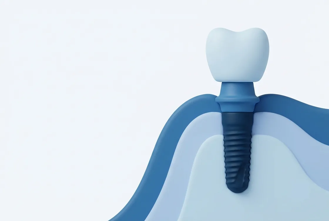 Ilustração esquemática de um implante dentário: coroa, pilar e parafuso de titânio no osso